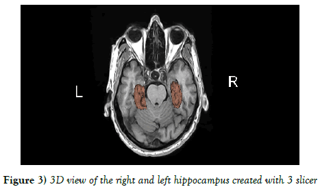 Anatomical-Variations-right-left-hippocampus