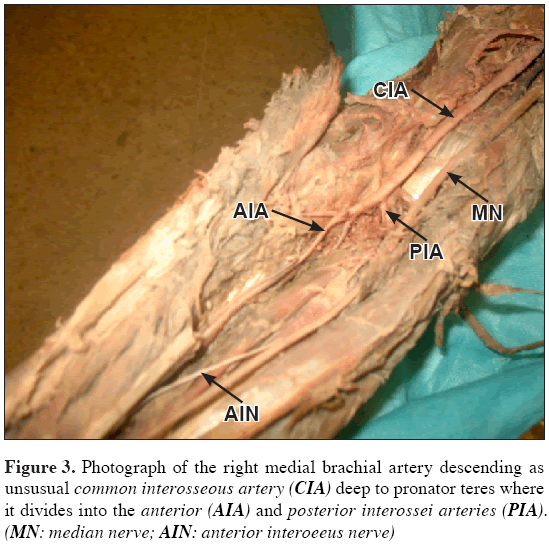 Anatomical-Variations-right-medial-brachial