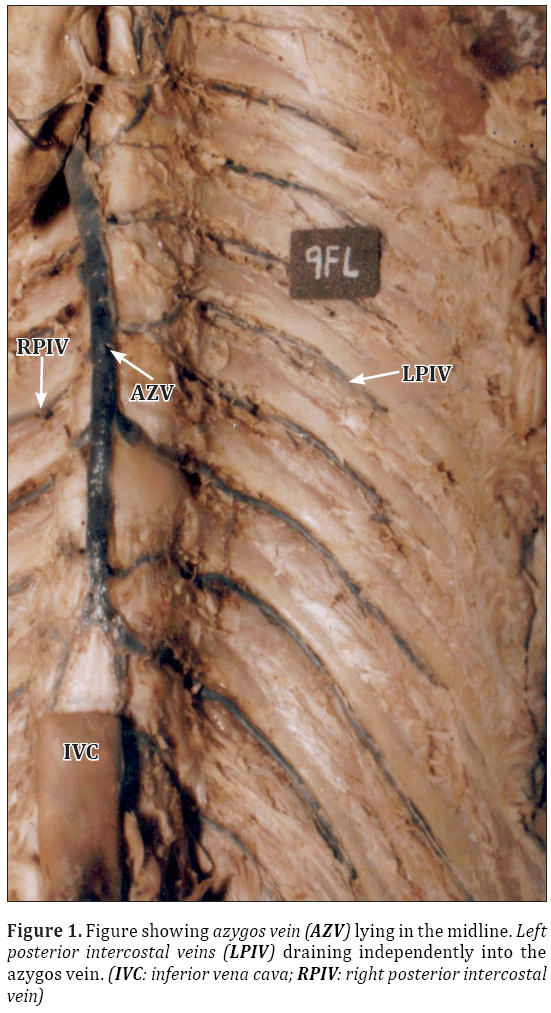 Anatomical-Variations-right-posterior-intercostal