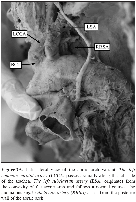 Anatomical-Variations-right-subclavian-artery