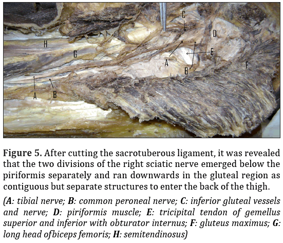 Anatomical-Variations-sacrotuberous-ligament