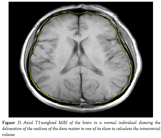 Anatomical-Variations-slices-calculate-intracranial