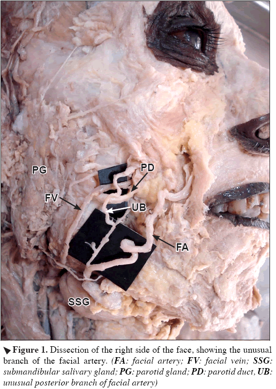 Anatomical-Variations-submandibular-salivary-gland
