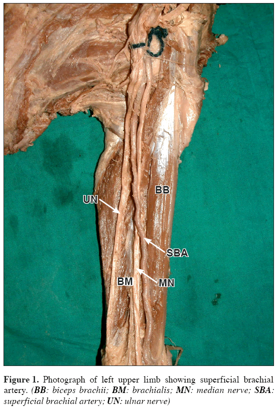 Anatomical-Variations-superficial-brachial-artery