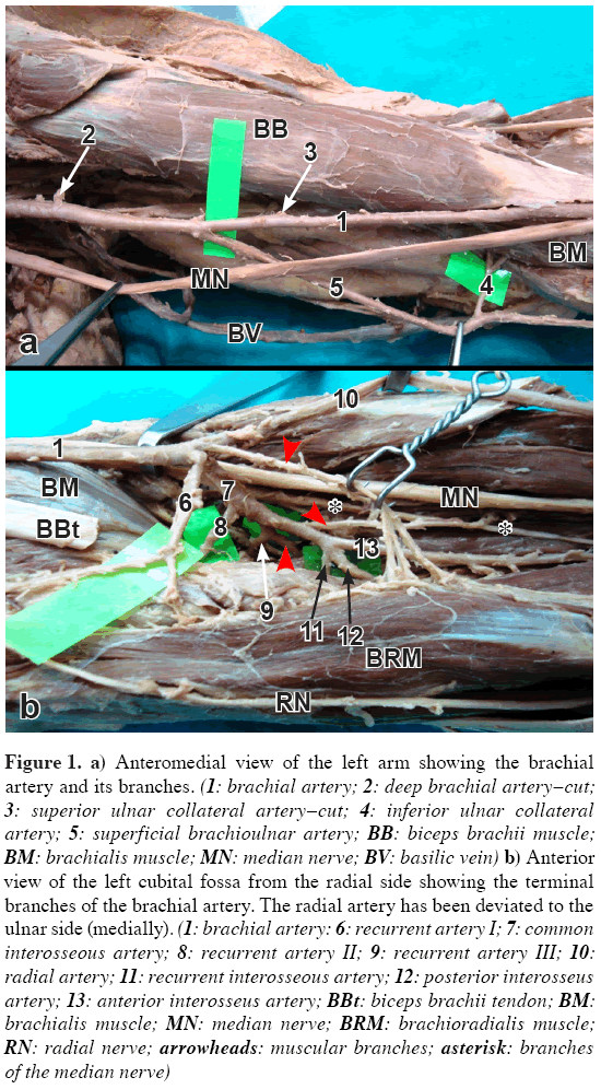 Anatomical-Variations-superficial-brachioulnar-artery