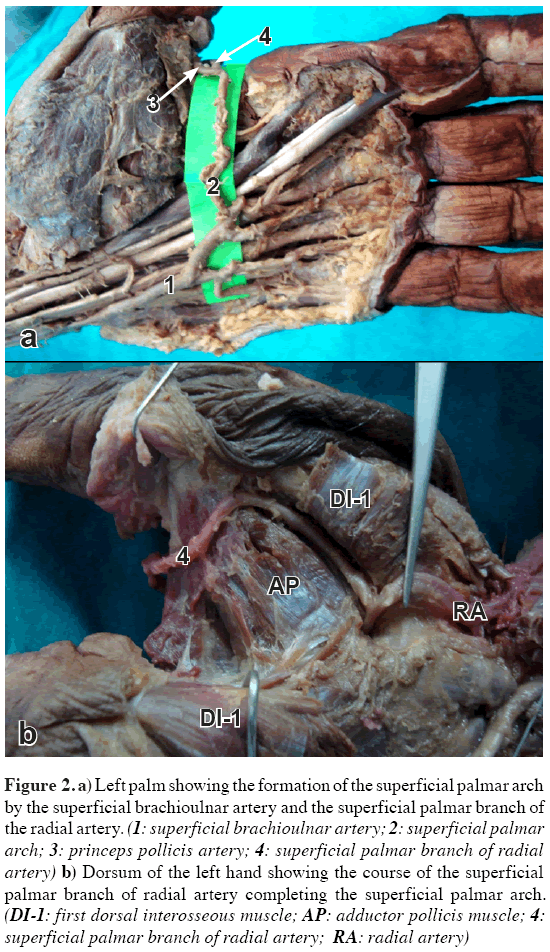 Anatomical-Variations-superficial-palmar-arch