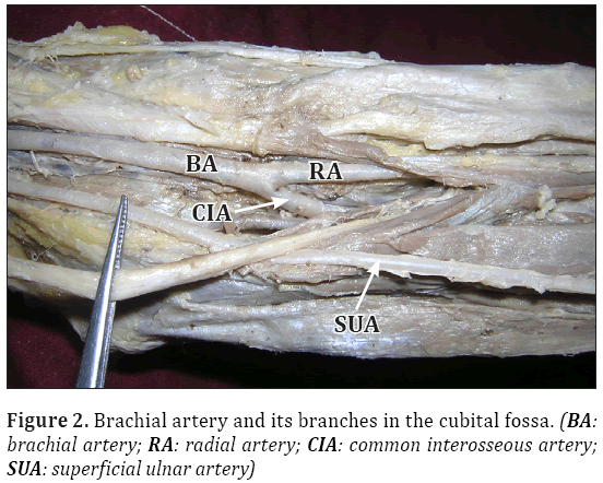 Anatomical-Variations-superficial-ulnar-artery