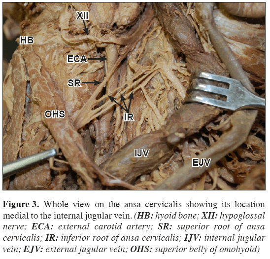 Anatomical-Variations-superior-belly-omohyoid