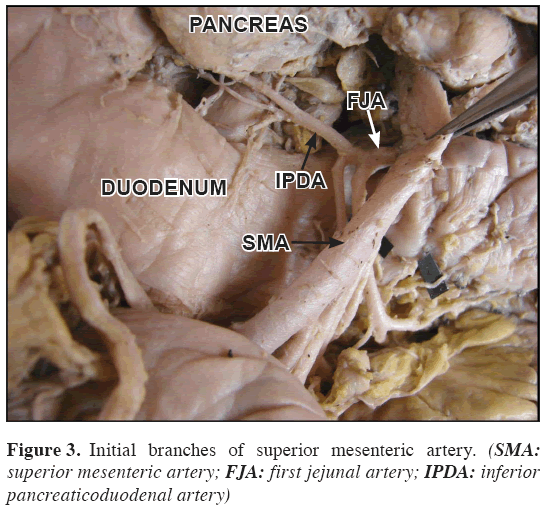 Anatomical-Variations-superior-mesenteric-artery