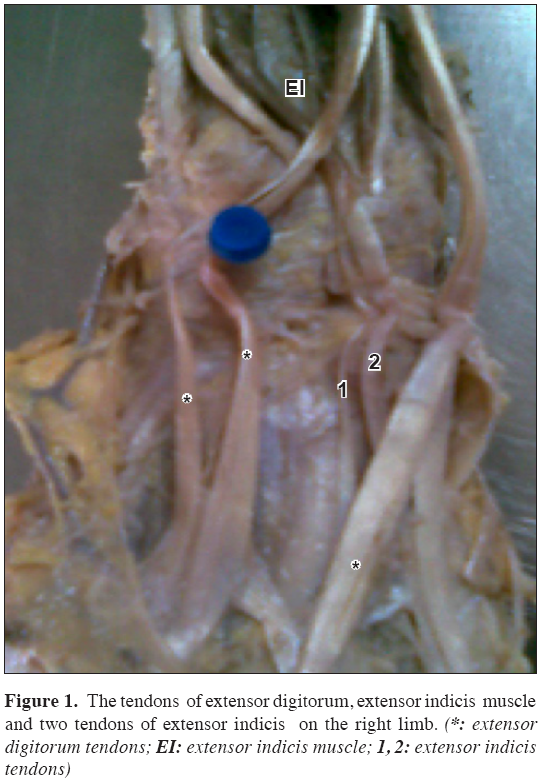 Anatomical-Variations-tendons-extensor-digitorum