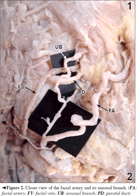 Anatomical-Variations-view-facial-artery