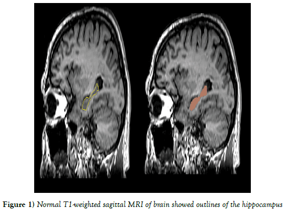 Anatomical-Variations-weighted-sagittal-MRI