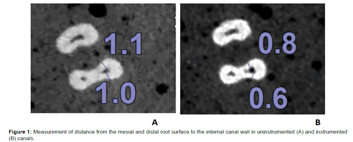 Annals-Medical-mesial-distal