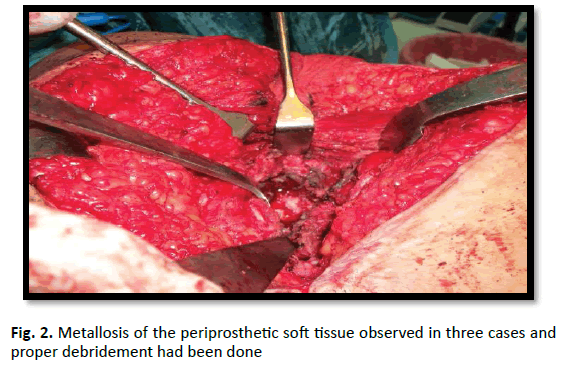 Orthopaedics-Trauma-Surgery-Metallosis