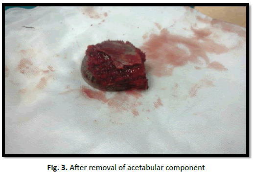 Orthopaedics-Trauma-Surgery-acetabular