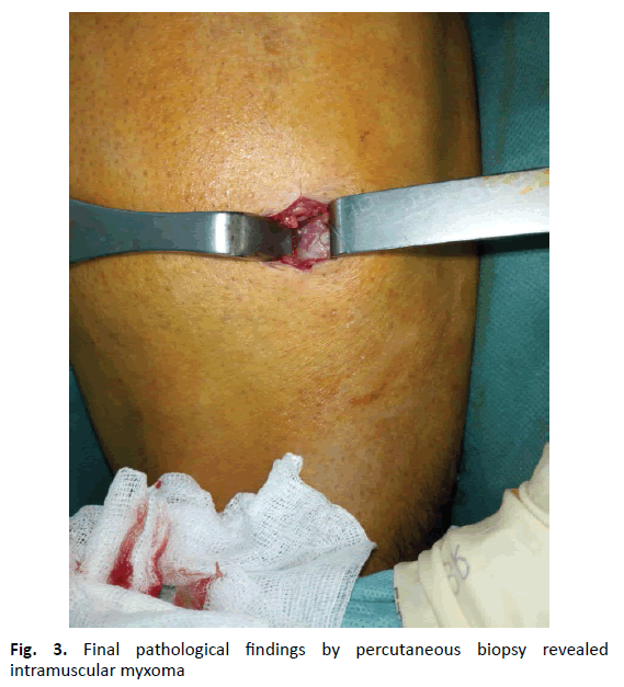 Orthopaedics-Trauma-Surgery-intramuscular