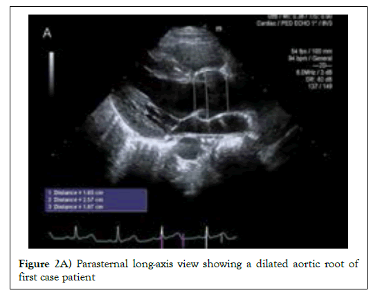 Pedia-Health-Care-dilated-aortic-root