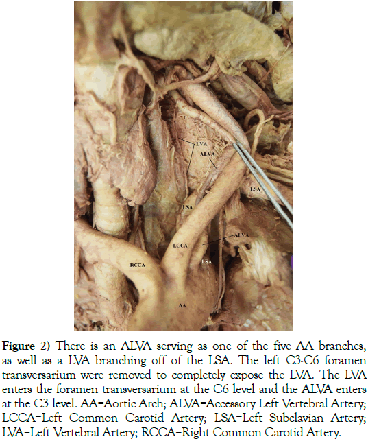 anatomical-variations-ALVA-serving