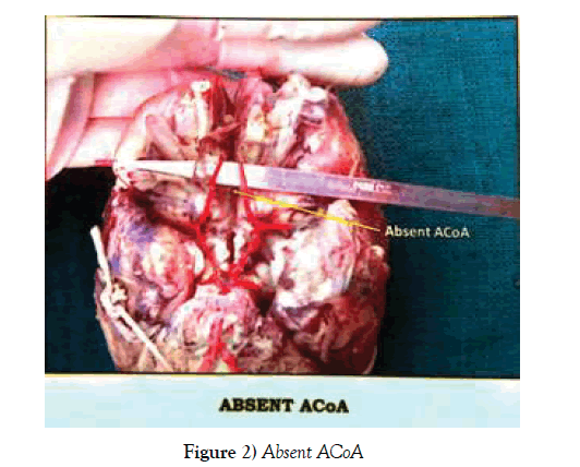 anatomical-variations-Absent