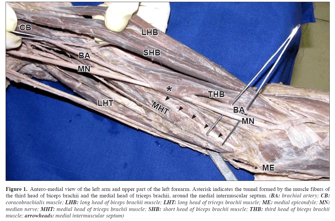 anatomical-variations-Antero-medial