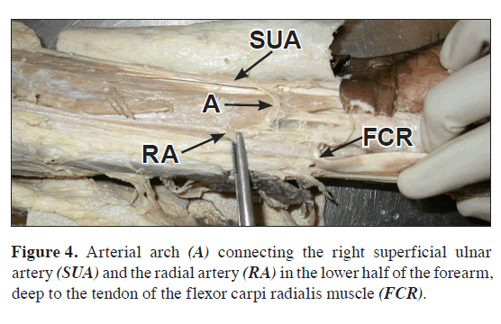 anatomical-variations-Arterial-arch