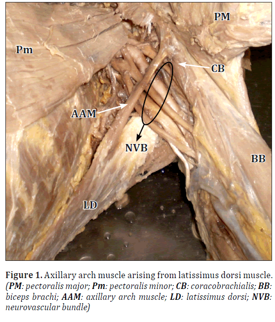 anatomical-variations-Axillary-muscle