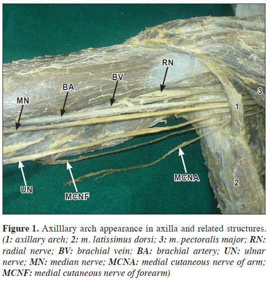 anatomical-variations-Axilllary-arch