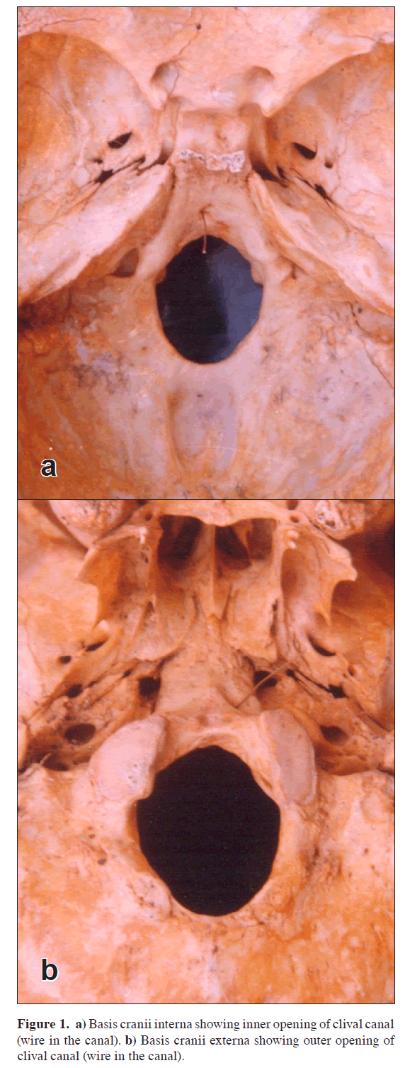 anatomical-variations-Basis-cranii