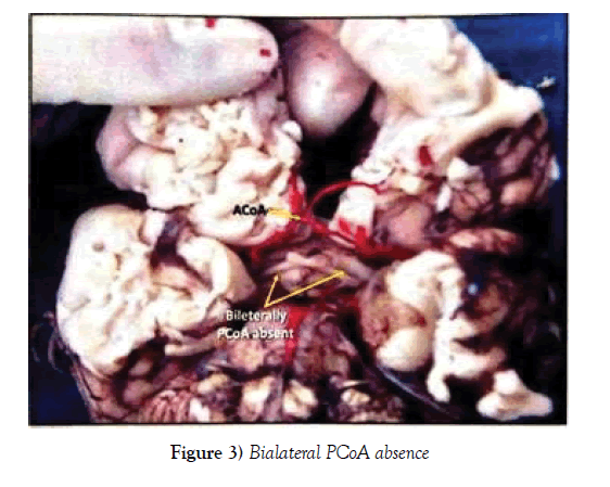 anatomical-variations-Bialateral