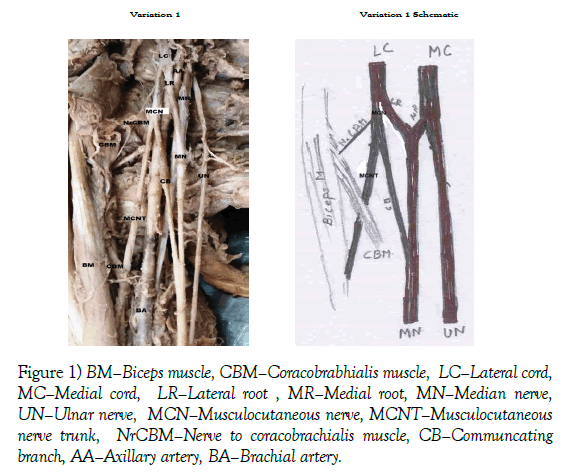 anatomical-variations-Biceps-muscle