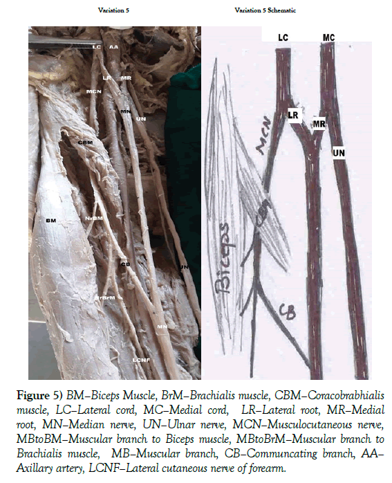anatomical-variations-Biceps-muscle