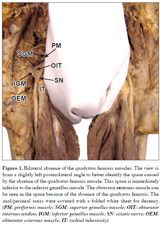 anatomical-variations-Bilateral-absence