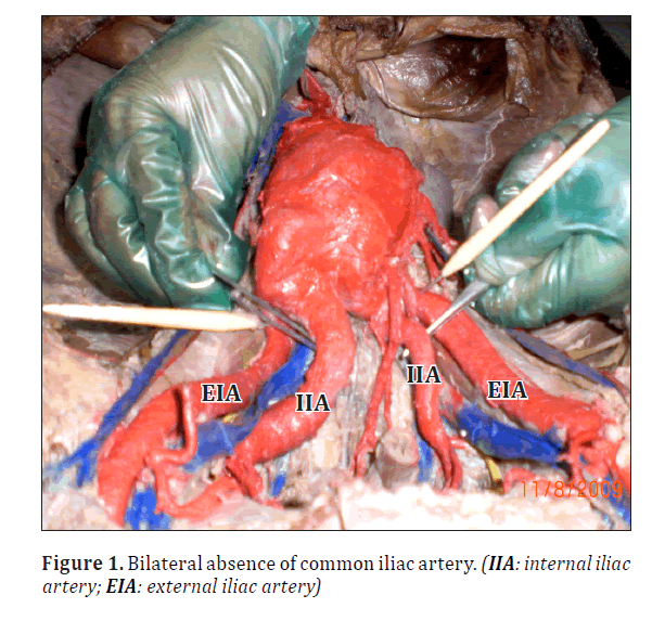 anatomical-variations-Bilateral-absence