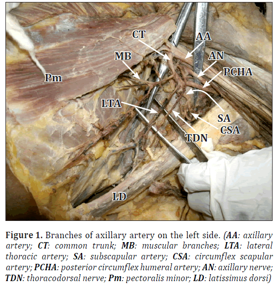 anatomical-variations-Branches-axillary