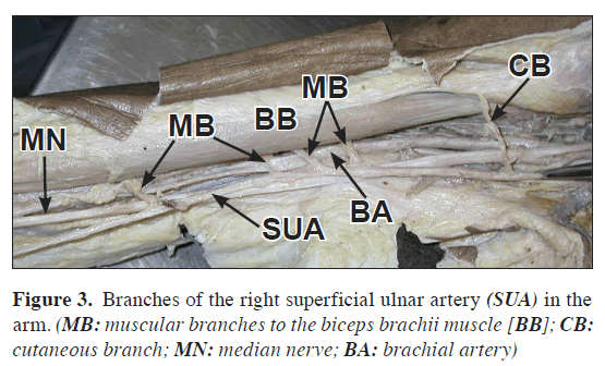 anatomical-variations-Branches-right