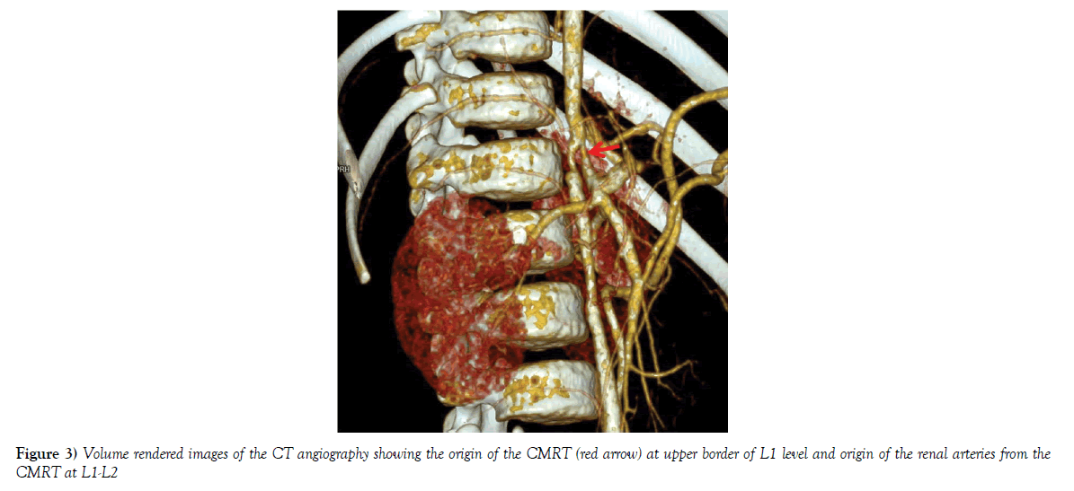 anatomical-variations-CT-angiography