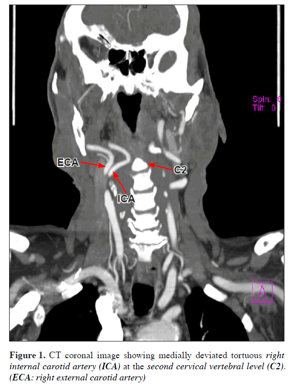 anatomical-variations-CT-coronal