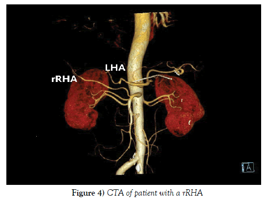 anatomical-variations-CTA-patient