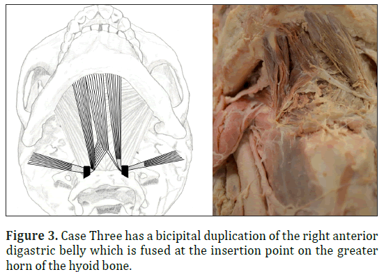 anatomical-variations-Case-Three