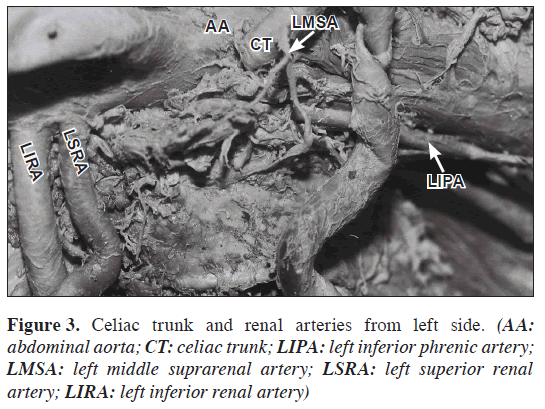 anatomical-variations-Celiac-trunk