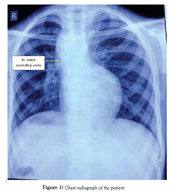 anatomical-variations-Chest-radiograph