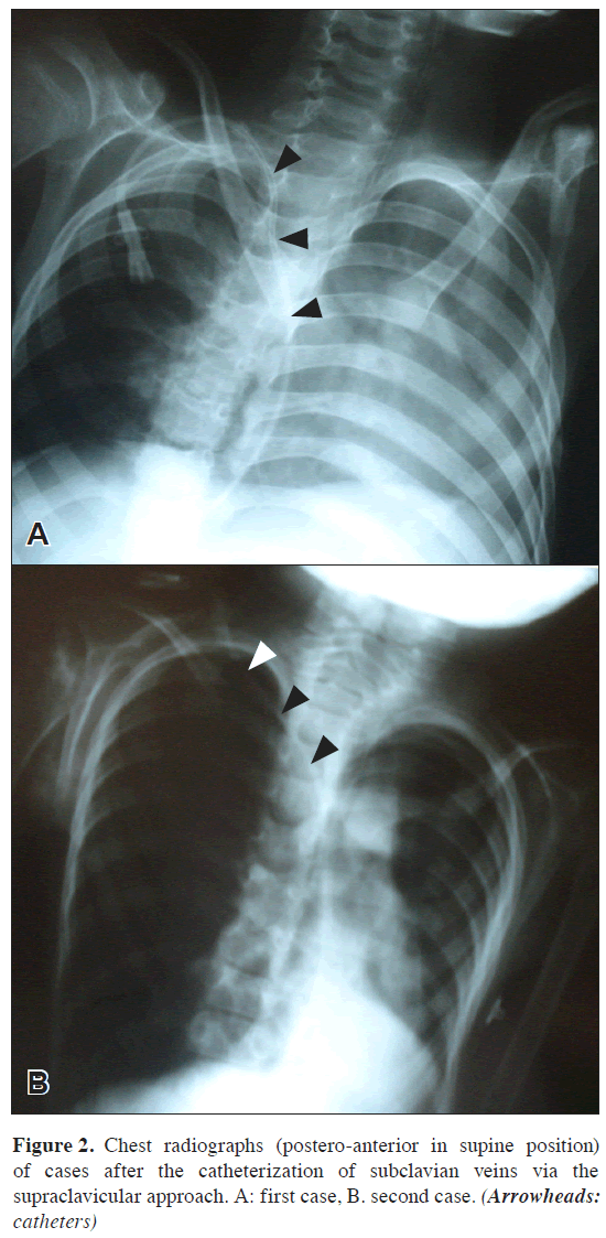 anatomical-variations-Chest-radiographs