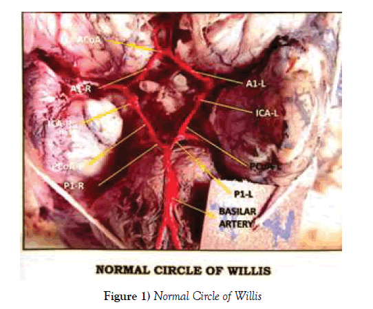 anatomical-variations-Circle-Willis