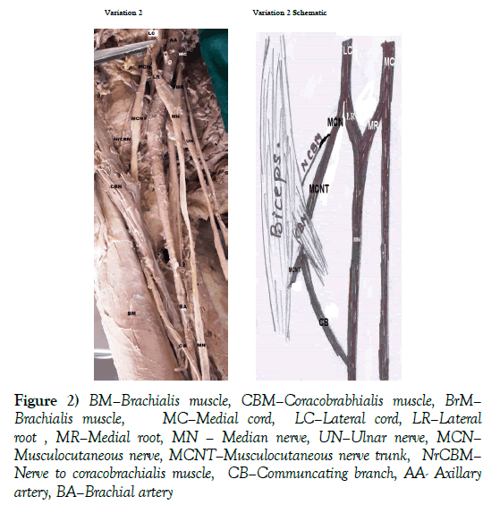 anatomical-variations-Coracobrabhialis-muscle