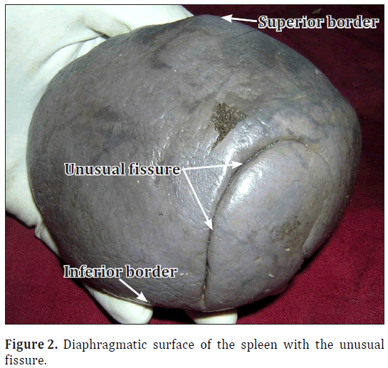 anatomical-variations-Diaphragmatic-surface