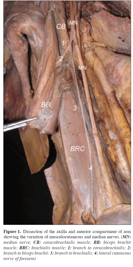 anatomical-variations-Dissection-axilla