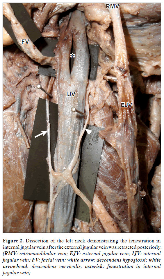 Variant Anatomy Of Fenestrated Internal Jugular Vein With