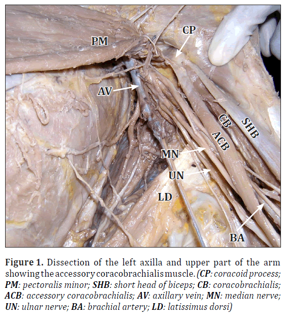 anatomical-variations-Dissection-left