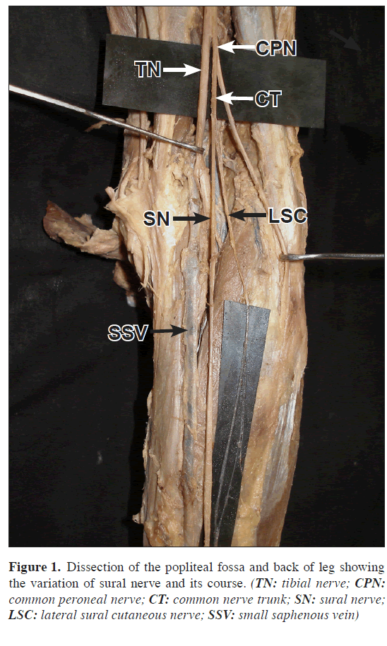 anatomical-variations-Dissection-popliteal