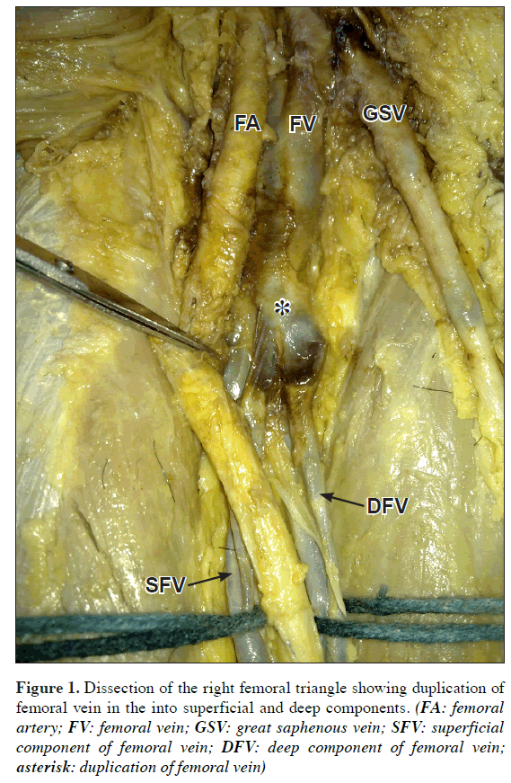 anatomical-variations-Dissection-right